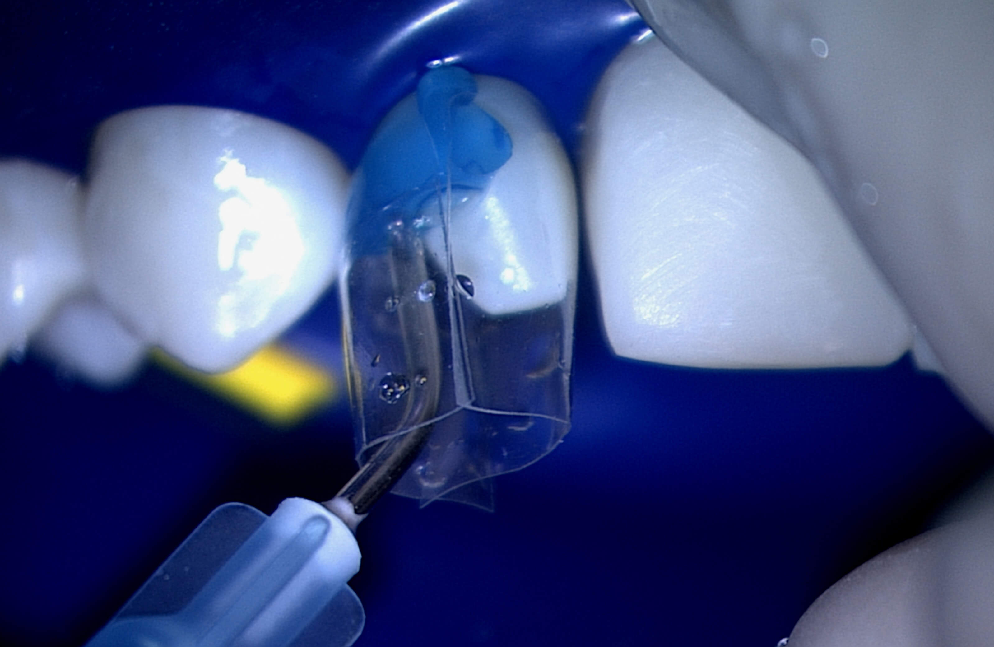 Bioclear Composite Overmolding for PostOrthodontic Undersized Teeth