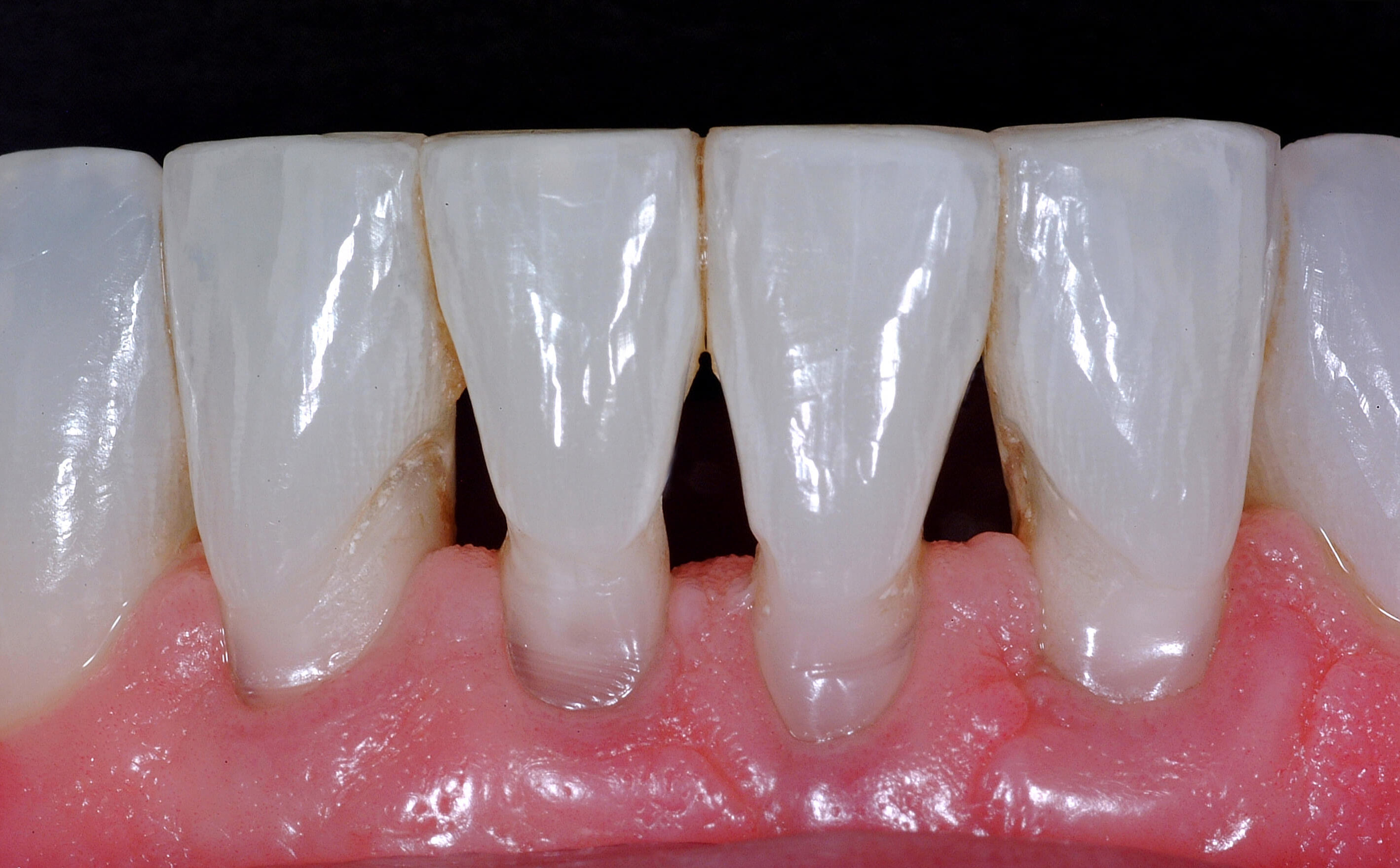 Level 3.1, 3.2, & 3.3 Anterior Solutions Advanced Anterior Bioclear