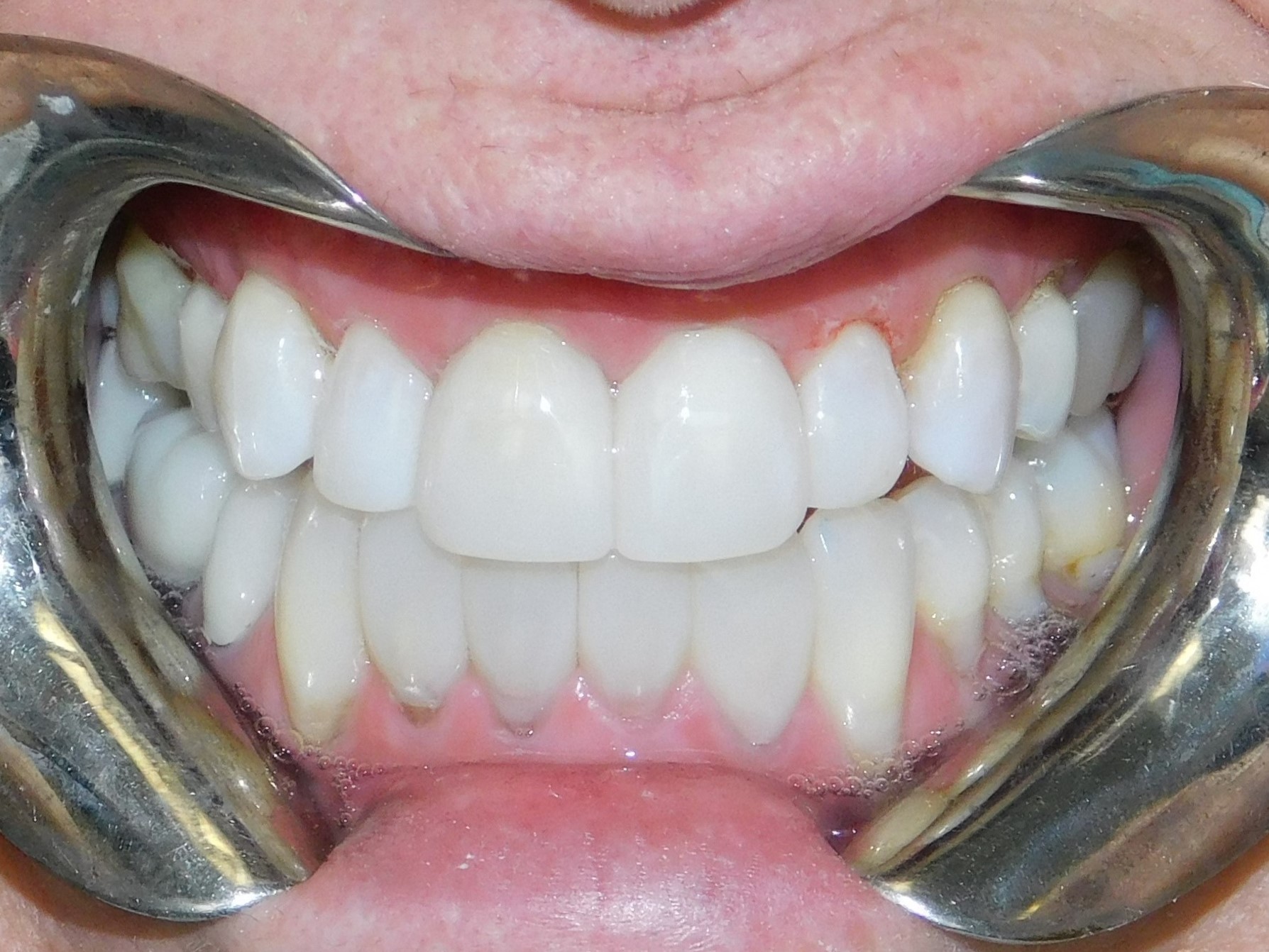Bioclear
