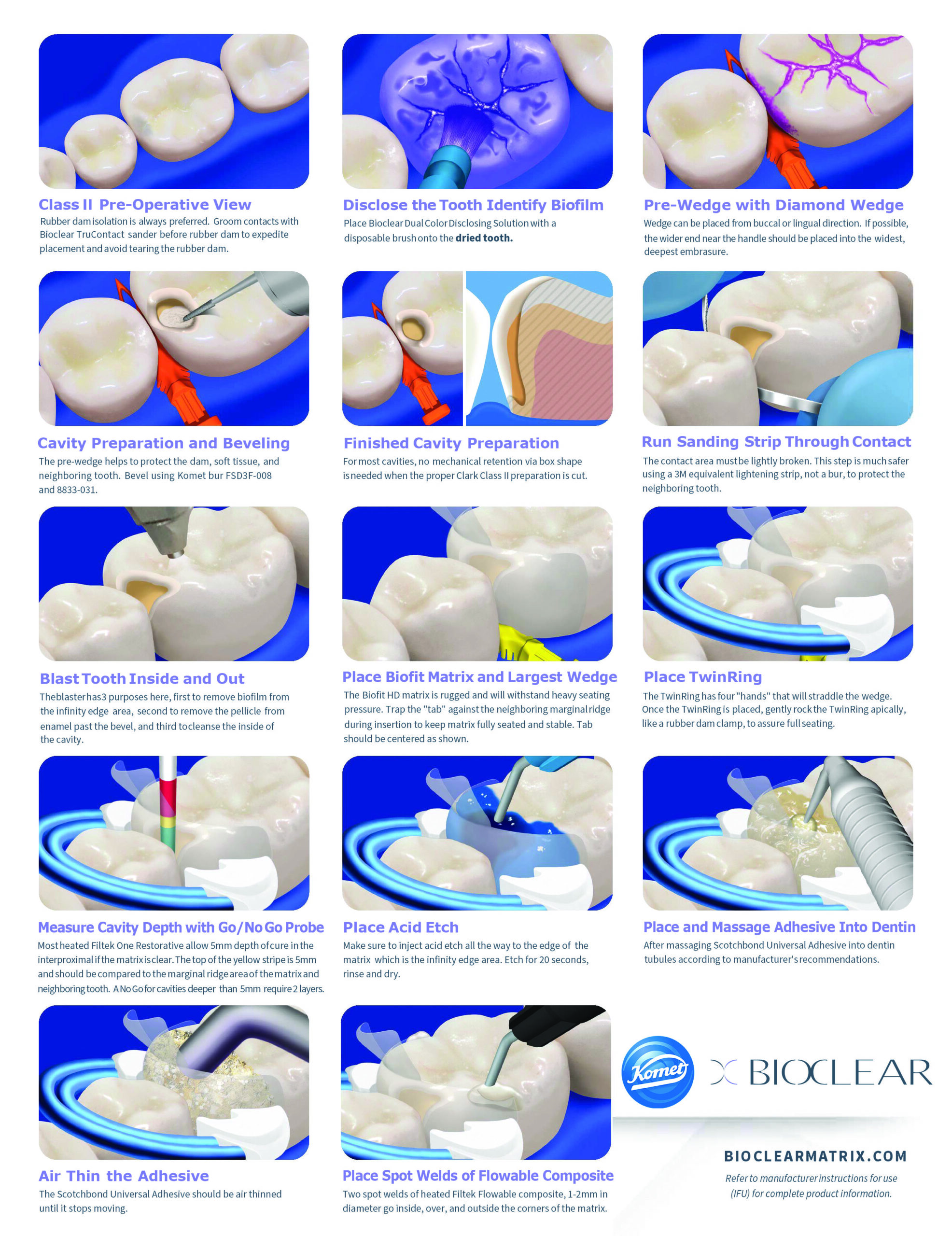 Illustrated Class II Procedural Guide Bioclear