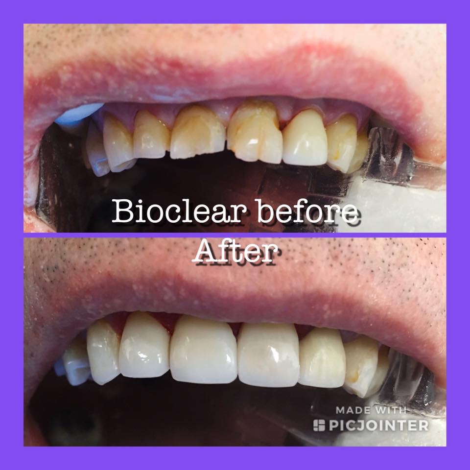 Bioclear