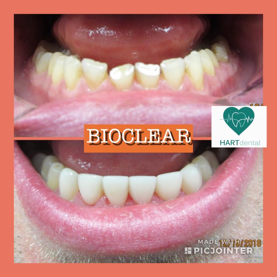 Bioclear