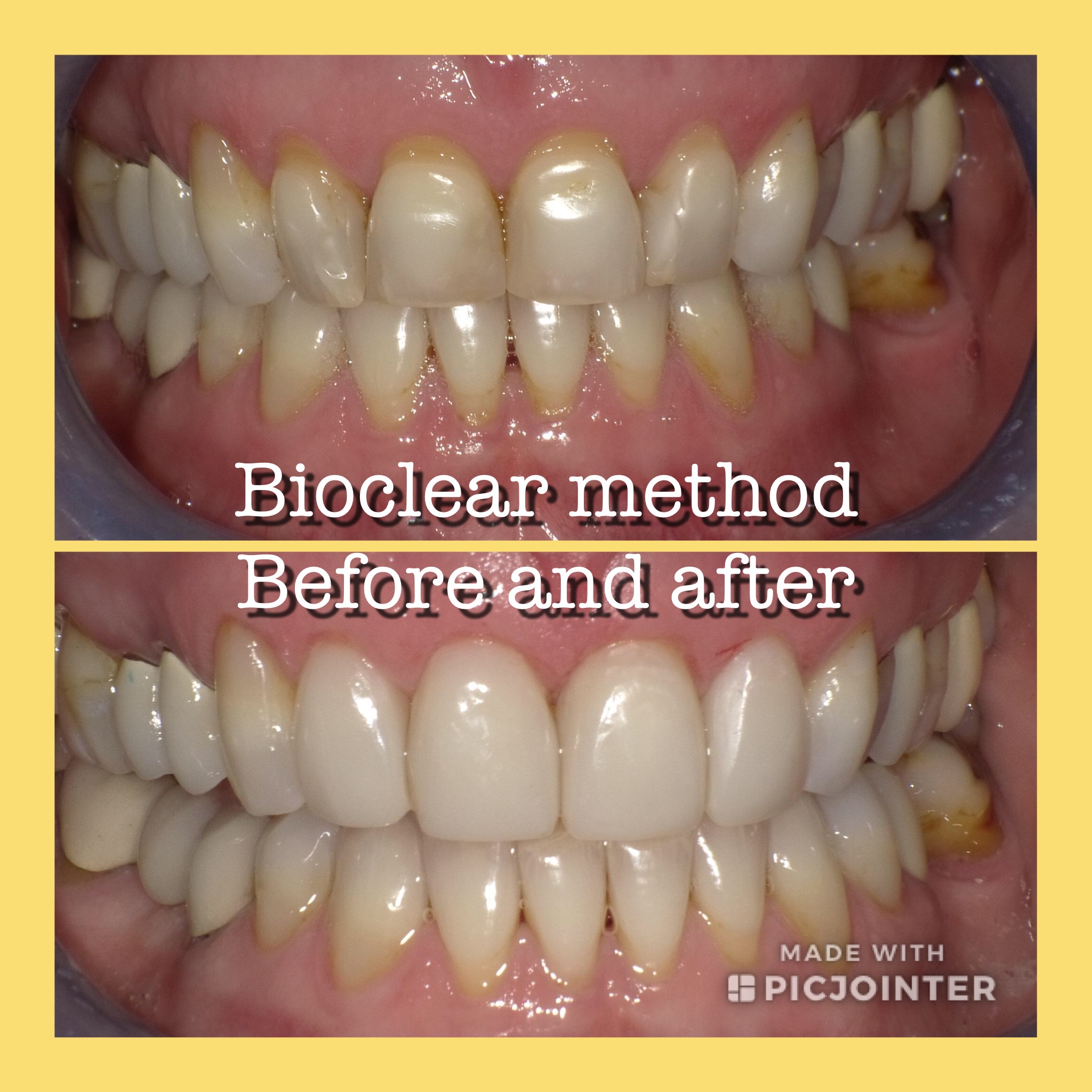 Bioclear