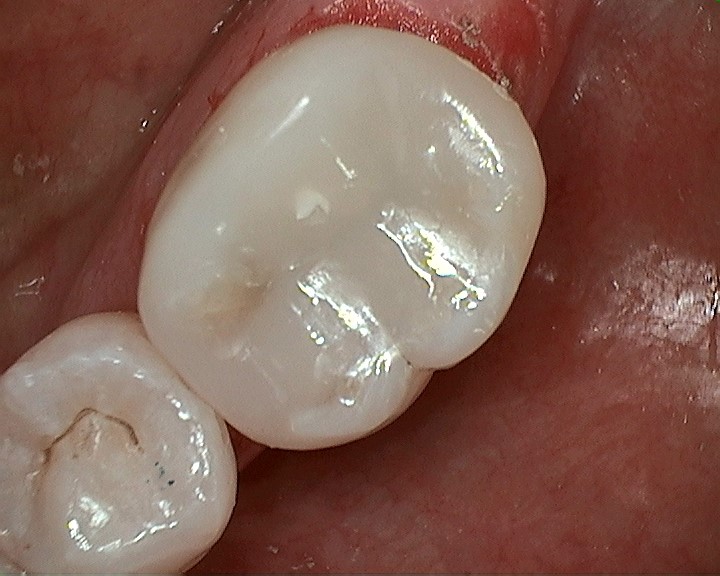Bioclear