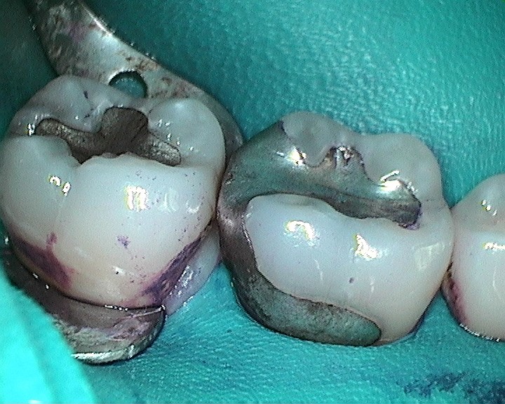 Bioclear
